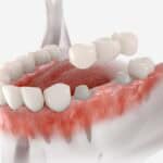 3D render showing how a dental bridge replaces missing teeth.