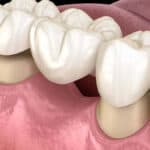 Illustration of a dental bridge fixed over two prepared teeth.