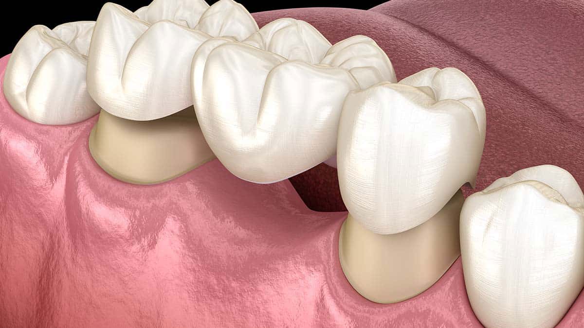 Illustration of a dental bridge fixed over two prepared teeth.